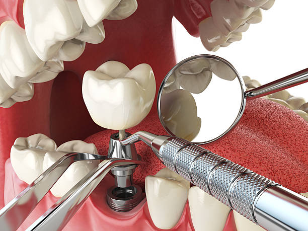 Best Emergency Tooth Extraction in Cape May, NJ